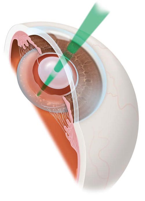 Cataract Evaluations Coastal Eye Care