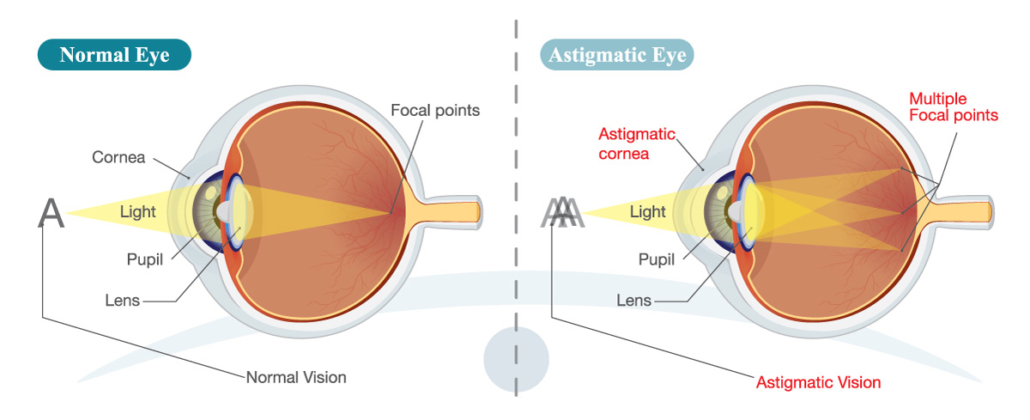 Cataract Care: TORIC – Coastal Eye Care